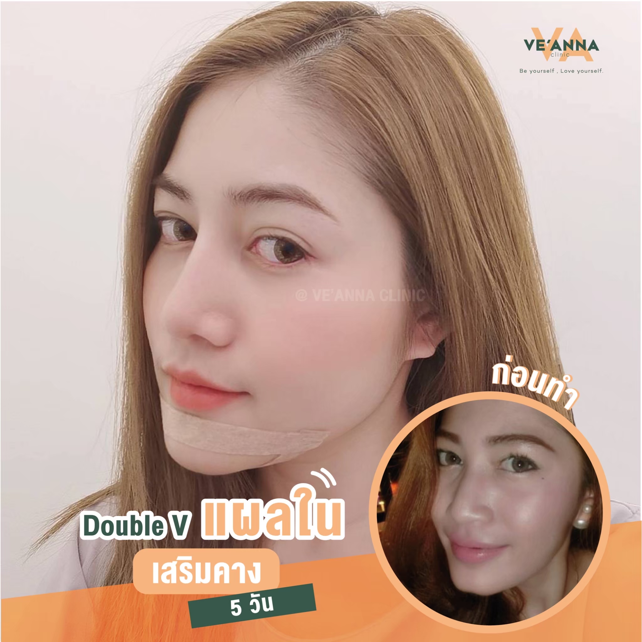 รีวิวเสริมคาง